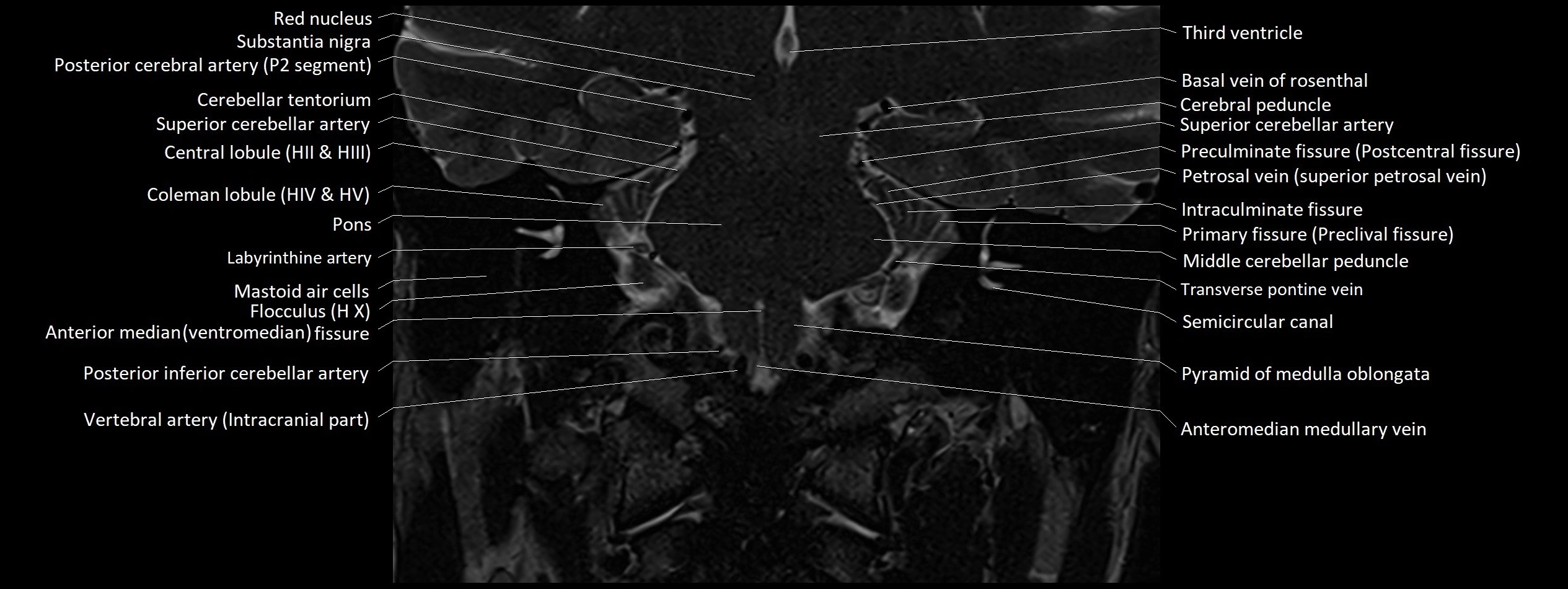 Anatomy of cerebellum coronal cross sectional 3T image 2.webp